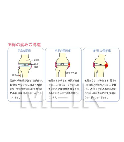 膝の関節の痛みの構造図